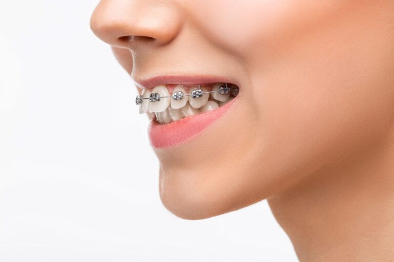Aparaty ortodontyczne - leczenie ortodontyczne zębów